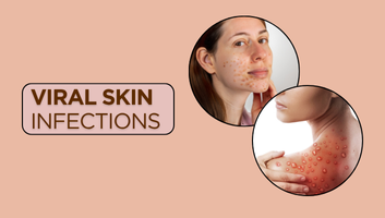 Viral Infections